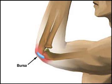 Olecranon Bursitis