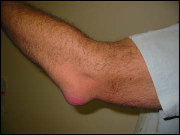 Painful Swelling